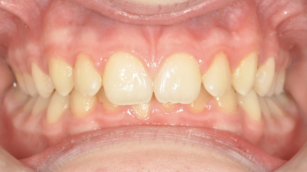 Avant traitement Avant traitement