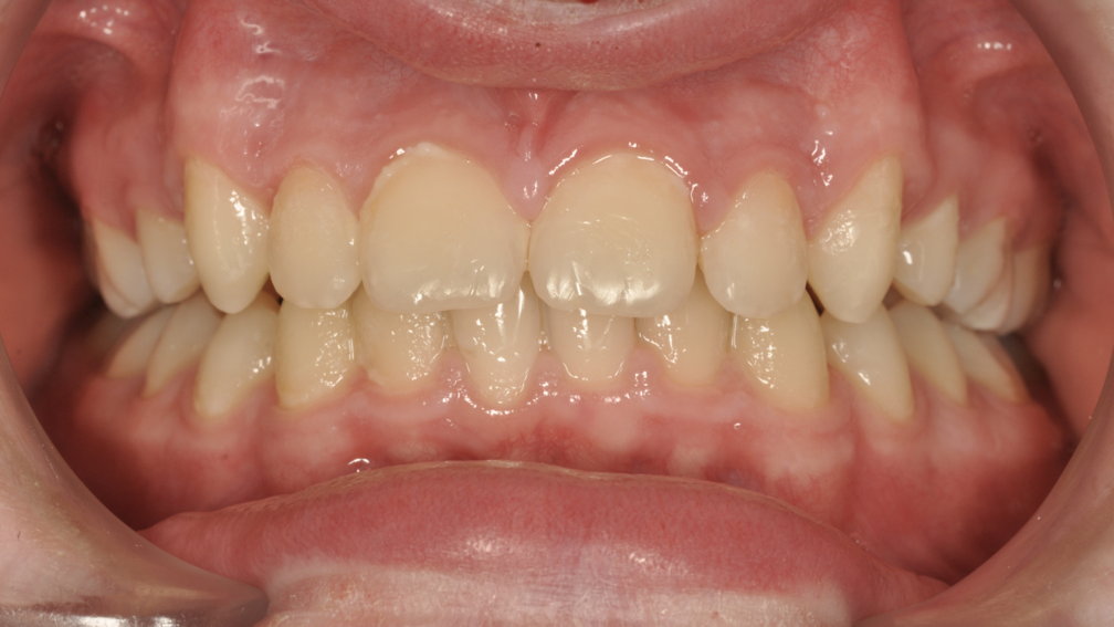 Après traitement Après traitement