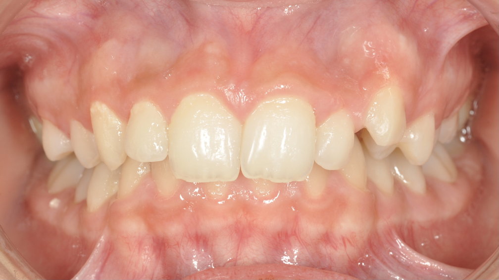 Avant traitement Avant traitement