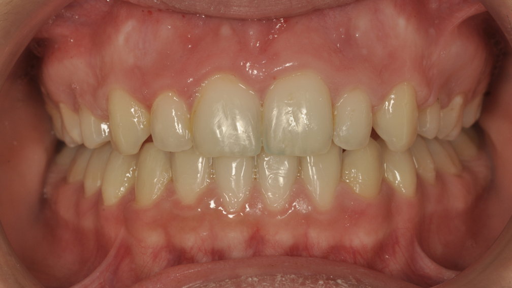 Après traitement Après traitement