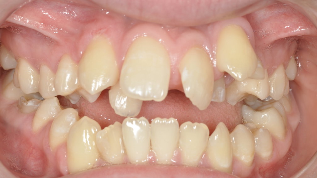 Avant traitement Avant traitement