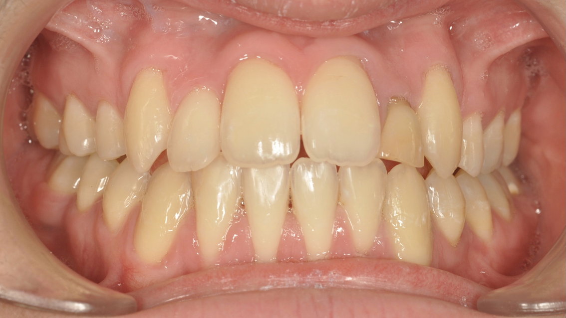 Après traitement Après traitement