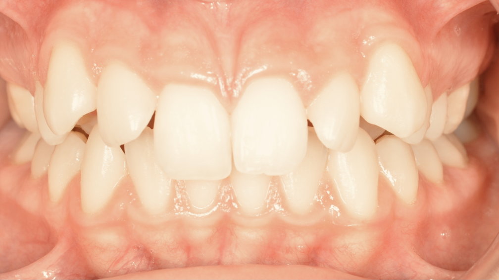 Avant traitement Avant traitement