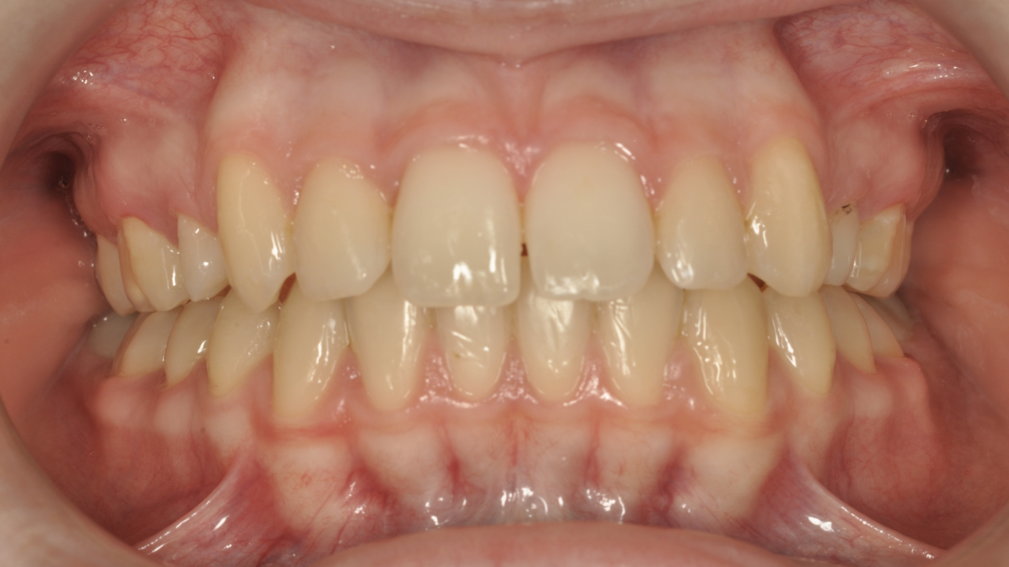 Après traitement Après traitement