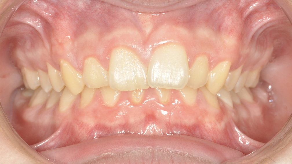 Avant traitement Avant traitement