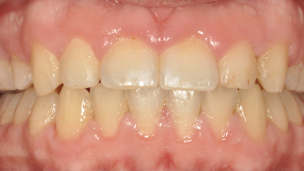 Après traitement Après traitement