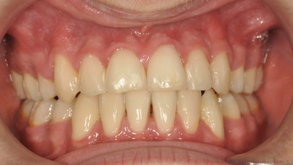 Après traitement Après traitement