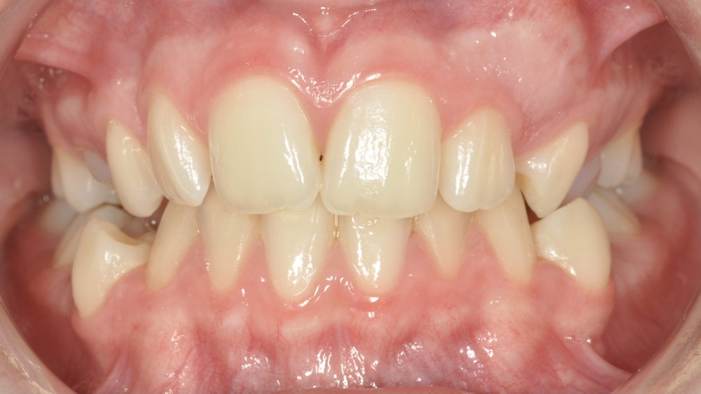 Avant traitement Avant traitement