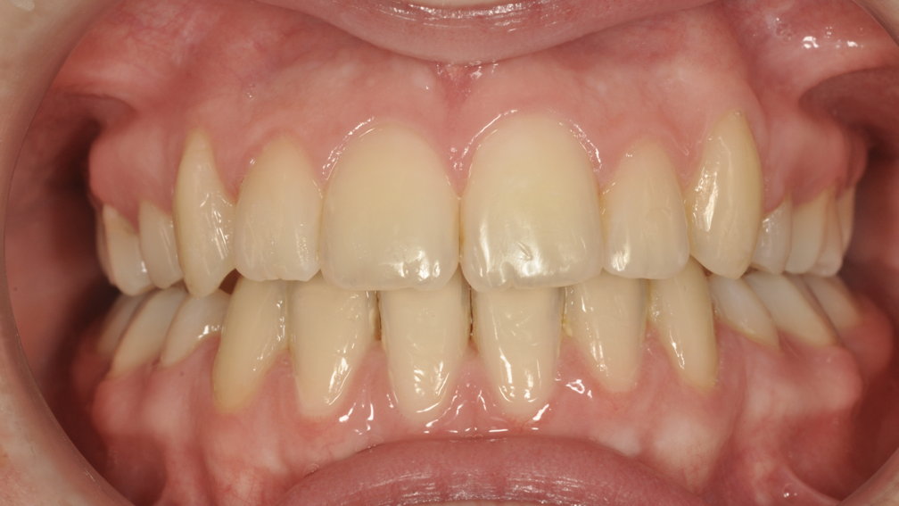 Après traitement Après traitement