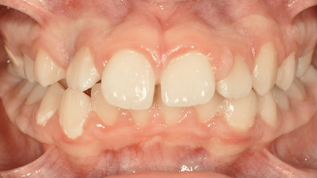 Avant traitement Avant traitement