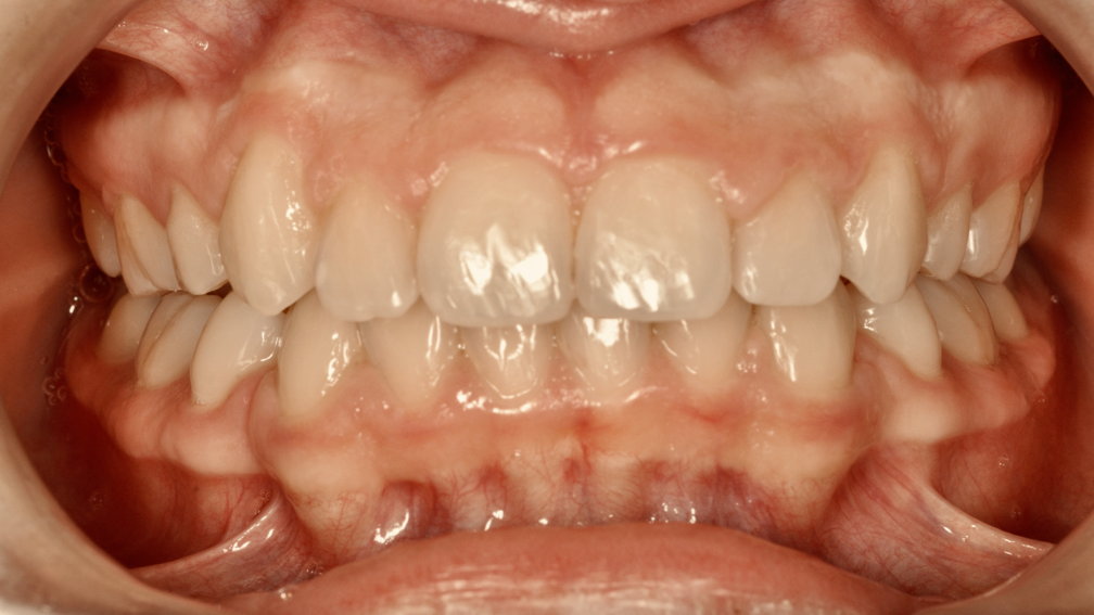 Après traitement Après traitement