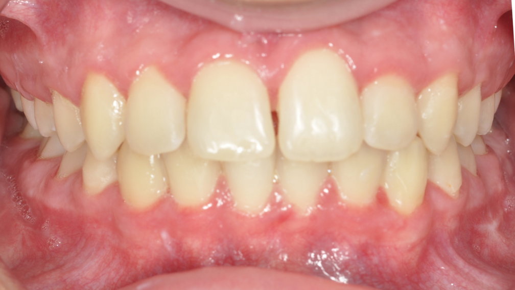 Après traitement Après traitement