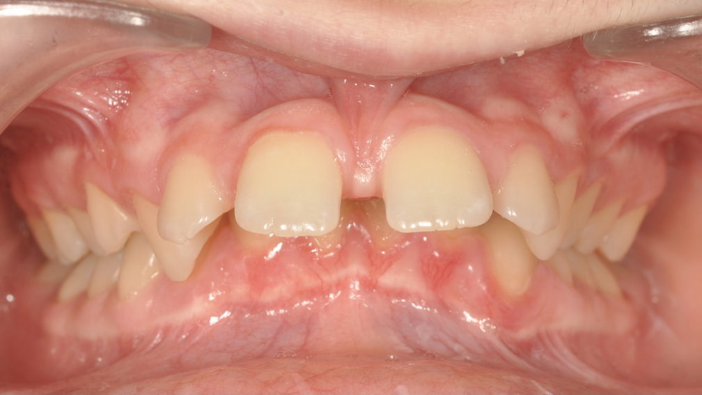 Avant traitement Avant traitement