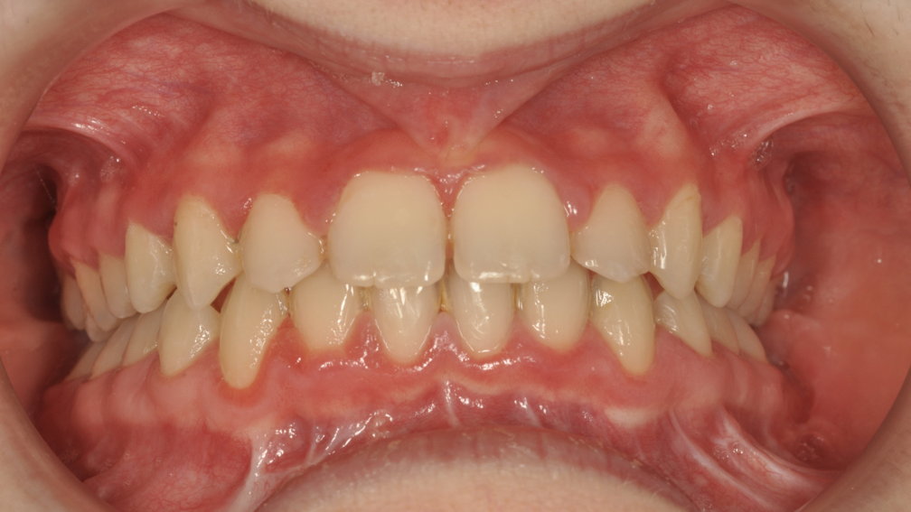 Après traitement Après traitement