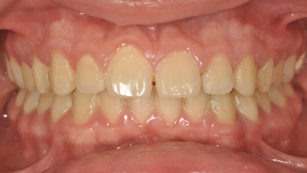 Après traitement Après traitement