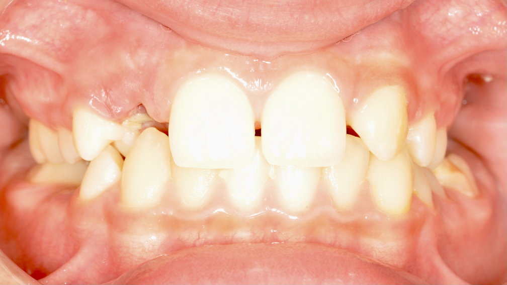 Avant traitement Avant traitement