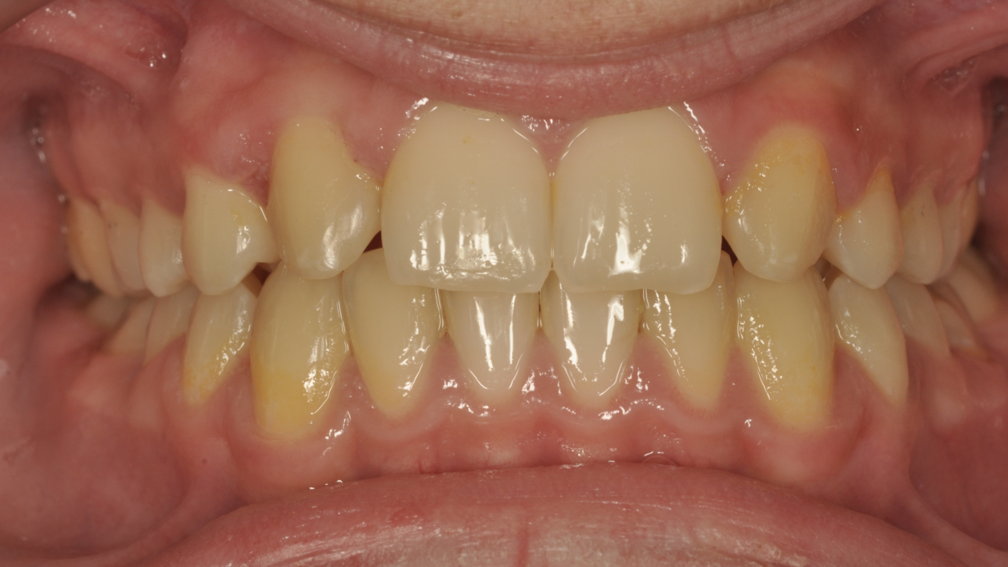 Après traitement Après traitement