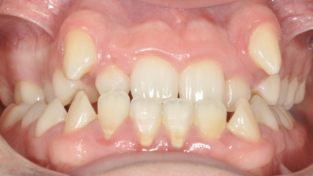 Avant traitement Avant traitement