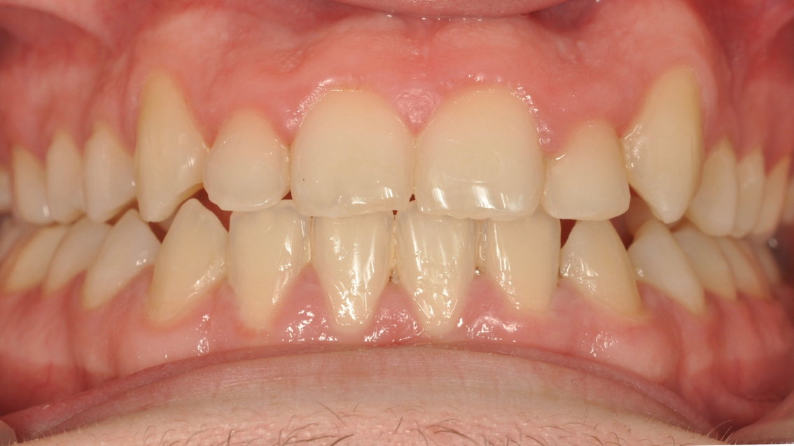 Après traitement Après traitement