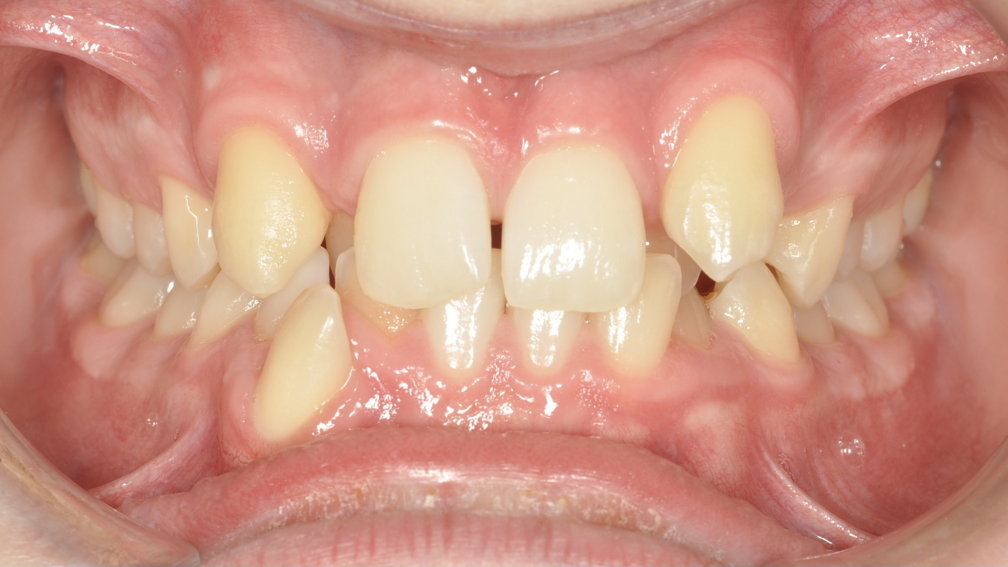 Avant traitement Avant traitement