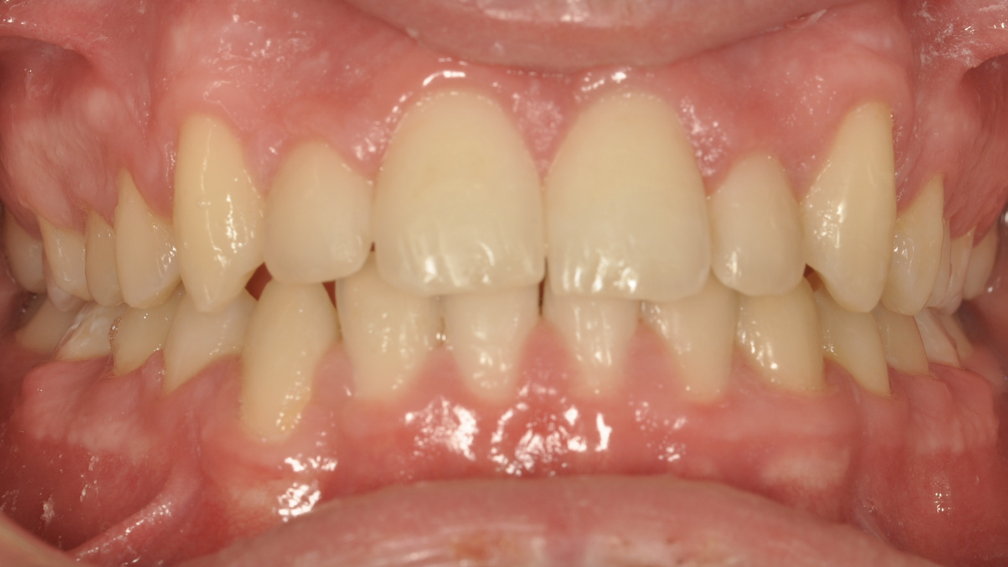 Après traitement Après traitement