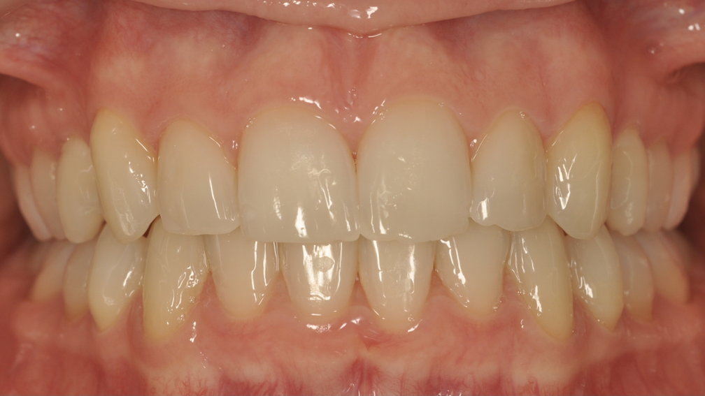 Après traitement Après traitement