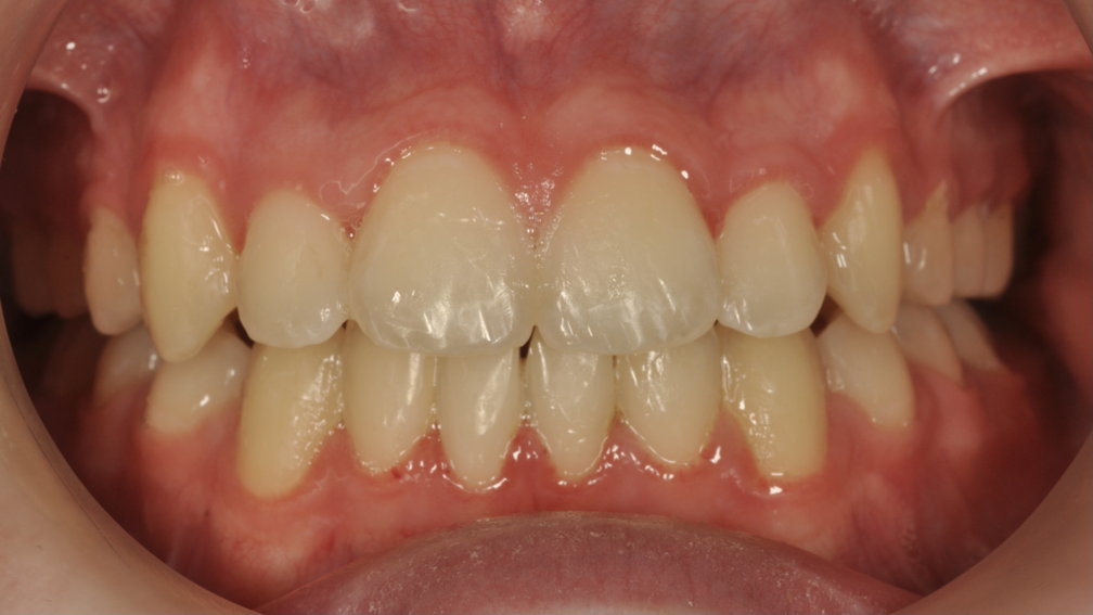 Après traitement Après traitement