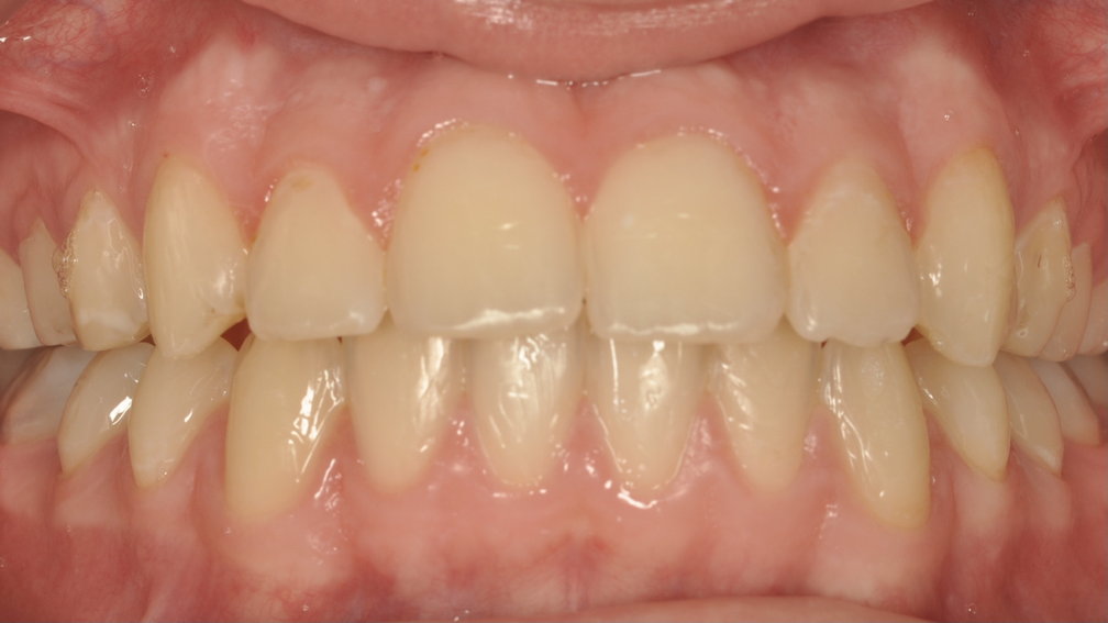 Après traitement Après traitement