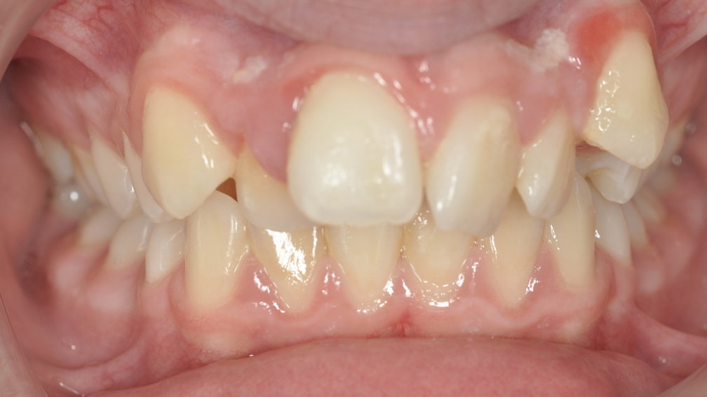 Avant traitement Avant traitement