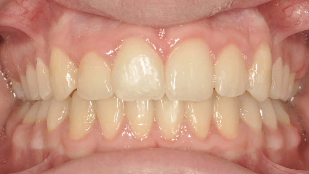 Après traitement Après traitement