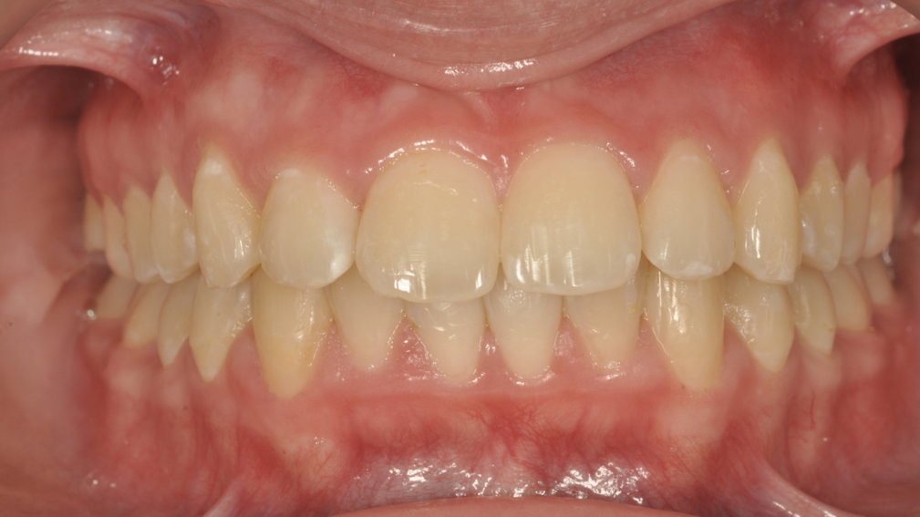 Après traitement Après traitement